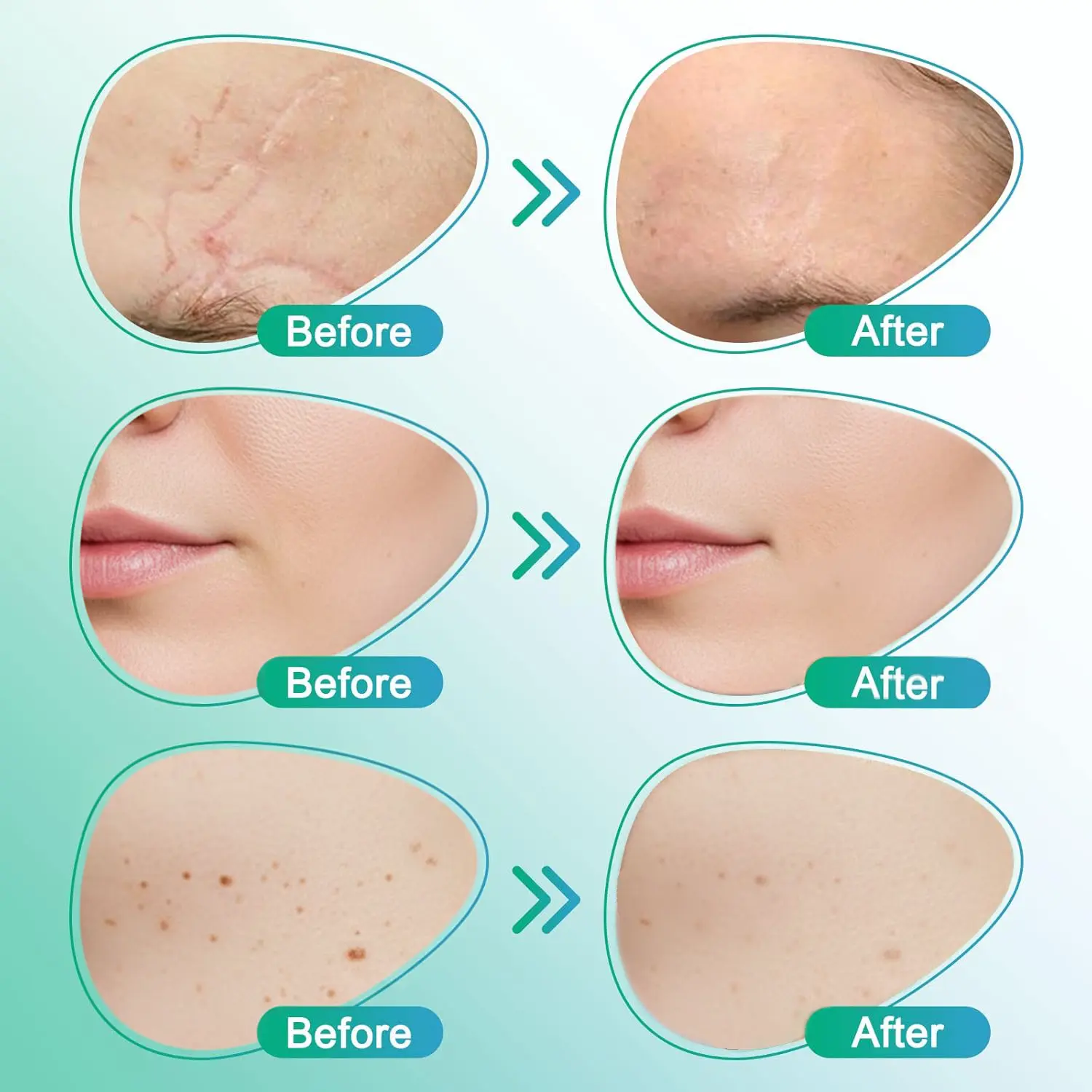 𝗖𝗮𝗿𝗲𝗕𝗿𝗲𝗲𝘇𝗲® 3-i-1 Microneedle Care Patch - Image 5