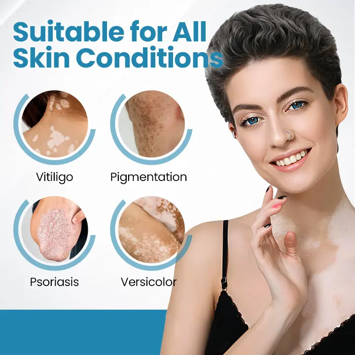 Acezozla® DermaBeam Vitiligo Therapy Device - Image 2