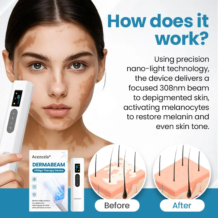 Acezozla® DermaBeam Vitiligo Therapy Device - Image 3