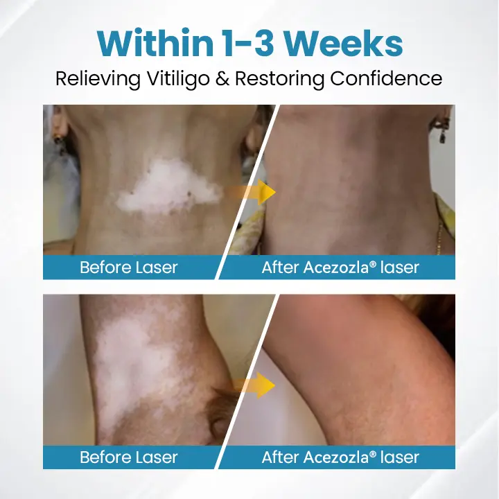 Acezozla® DermaBeam Vitiligo Therapy Device - Image 5