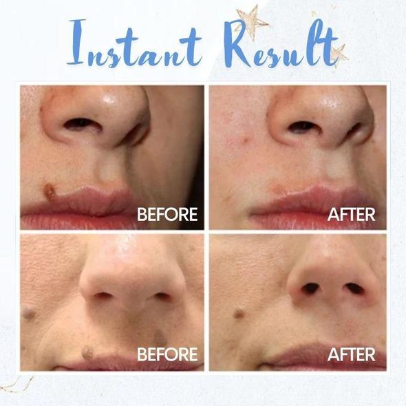 Pen til pletfjernelse - Image 2